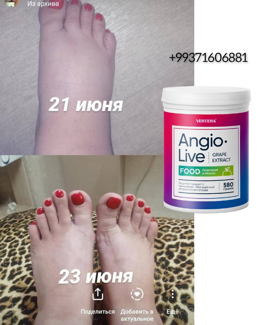 Aýak çişmesine garşy kömek etjek tebigy melhem. Angiolive Apple. 