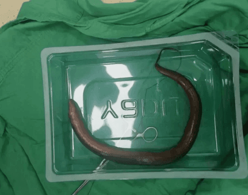 Hytaýda lukmanlar erkek kişiniň garnyndan diri ýylanbalyk tapdylar