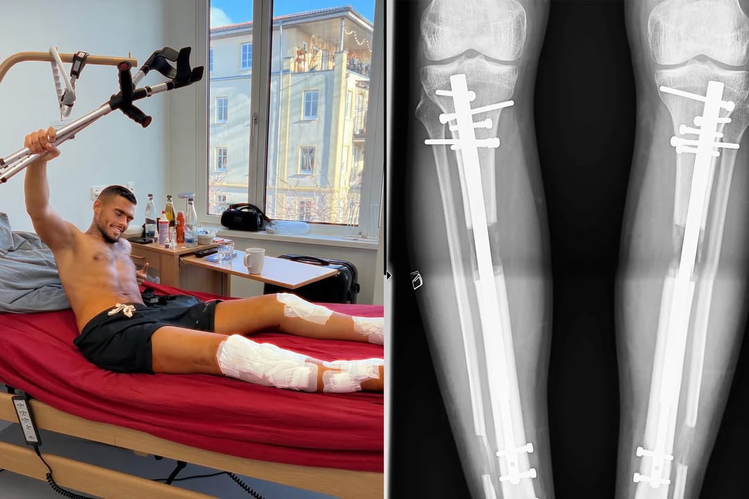 Germaniýaly aýaklaryny uzaltmak üçin iki operasiýa geçirdi