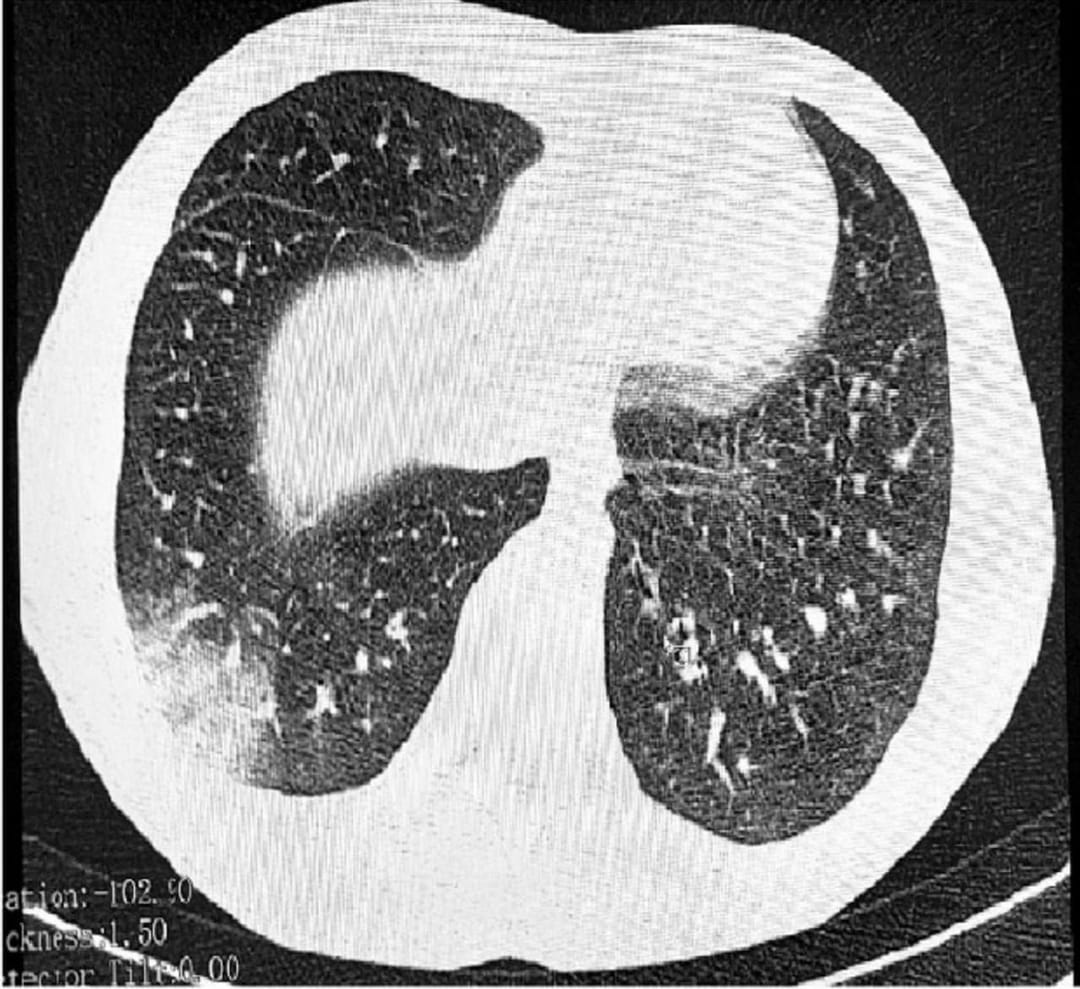 Russia reports first cases of "vaper disease" EVALI